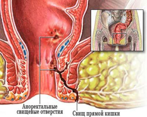 Свищ прямой кишки